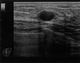 乳腺エコー検査